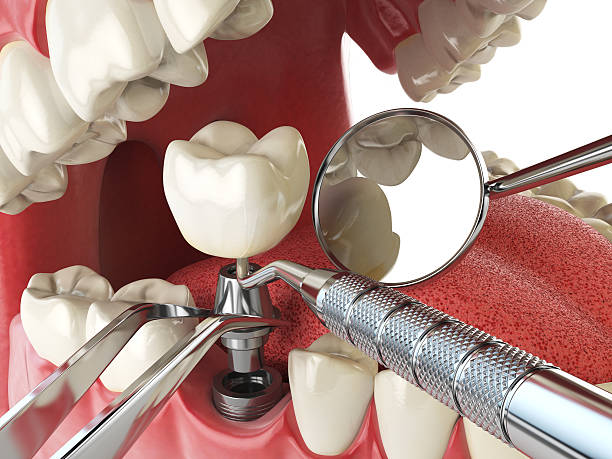 Best Emergency Dentist for Lost Fillings or Crowns in Gary, IN